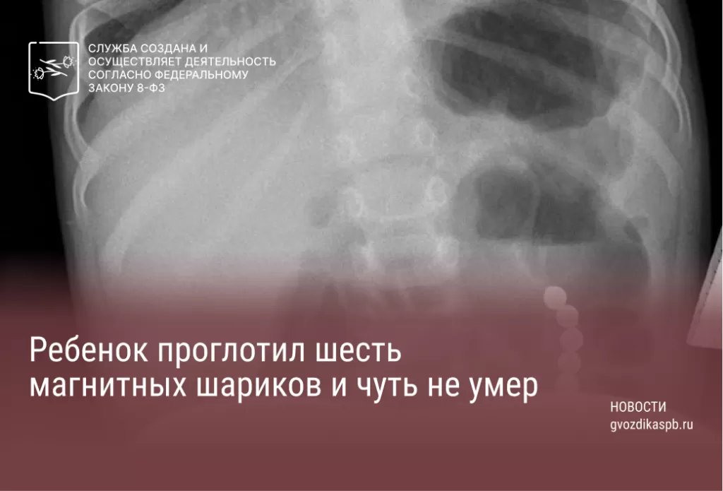 Ребенок проглотил шесть магнитных шариков и чуть не умер